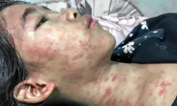 Çin’de Yeni Virüs Alarmı: Chikungunya Vakaları 1700’ü Aştı, Acil Durum İlan Edildi