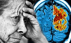 Günlük Yaşamda Görülen Küçük Değişiklikler Alzheimer’ın Erken Habercisi Olabilir