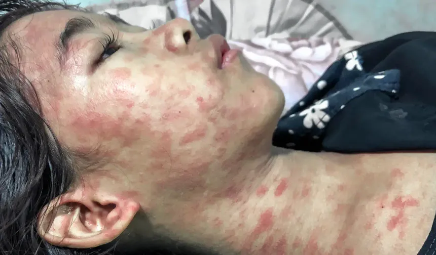 Çin’de Yeni Virüs Alarmı: Chikungunya Vakaları 1700’ü Aştı, Acil Durum İlan Edildi
